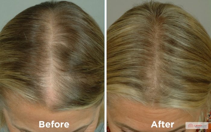 LaserCap HD+ Non-Surgical Hair Restoration