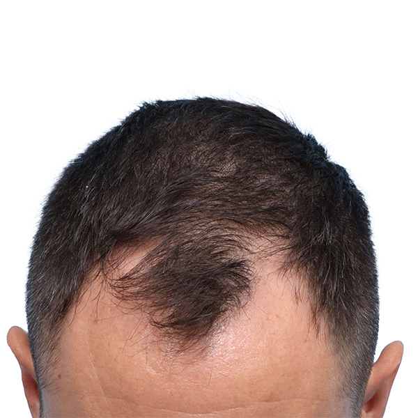 Fue Before and After | Dr. Jeffrey Wise