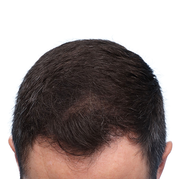 Fue Before and After | Dr. Jeffrey Wise