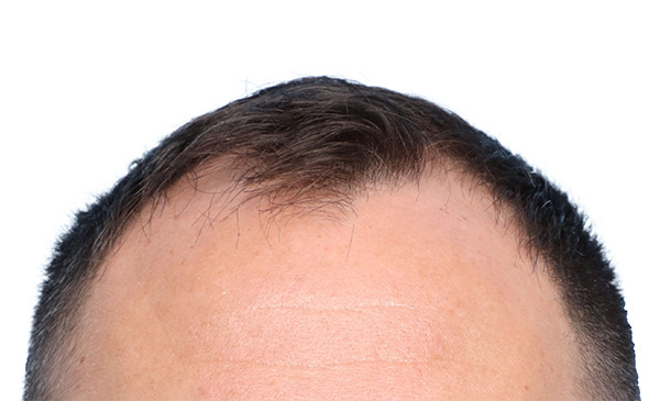 Fue Before and After | Dr. Jeffrey Wise