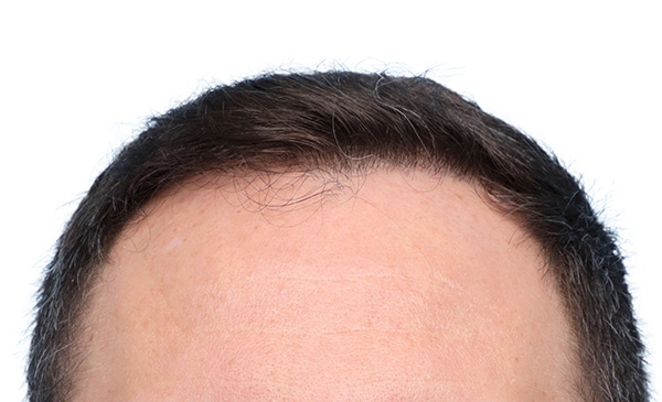 Fue Before and After | Dr. Jeffrey Wise