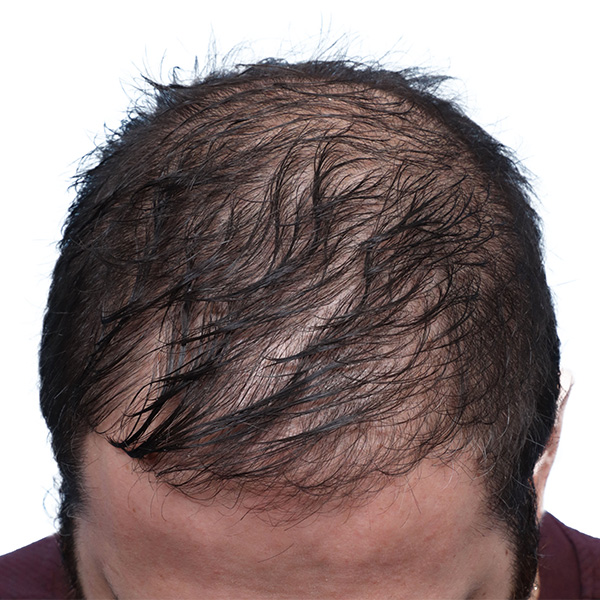 Fue Before and After | Dr. Jeffrey Wise