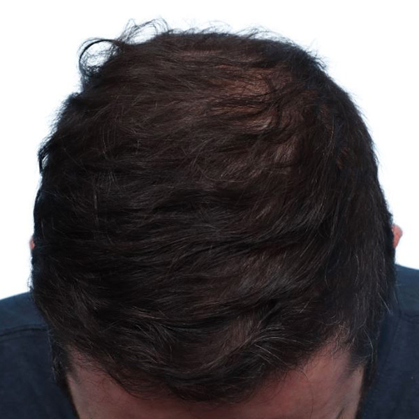 Fue Before and After | Dr. Jeffrey Wise