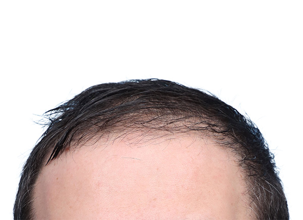 Fue Before and After | Dr. Jeffrey Wise