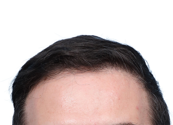 Fue Before and After | Dr. Jeffrey Wise