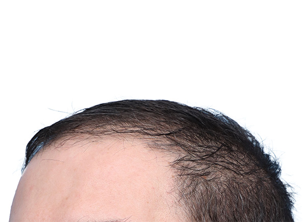 Fue Before and After | Dr. Jeffrey Wise