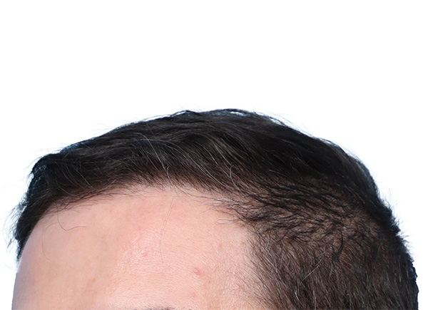 Fue Before and After | Dr. Jeffrey Wise