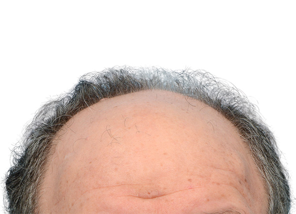 Fue Before and After | Dr. Jeffrey Wise