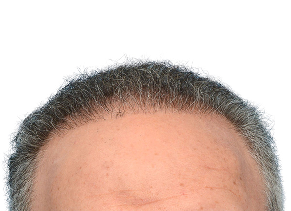 Fue Before and After | Dr. Jeffrey Wise