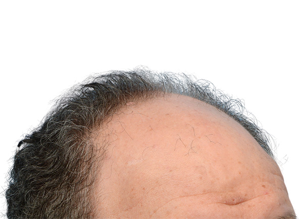 Fue Before and After | Dr. Jeffrey Wise