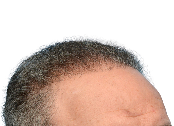 Fue Before and After | Dr. Jeffrey Wise