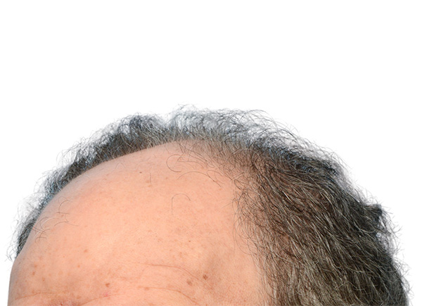 Fue Before and After | Dr. Jeffrey Wise