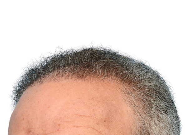 Fue Before and After | Dr. Jeffrey Wise