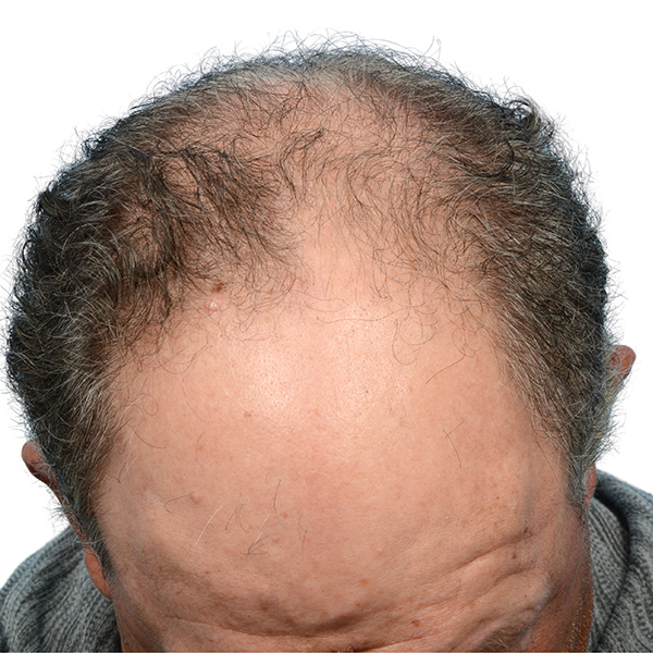 Fue Before and After | Dr. Jeffrey Wise