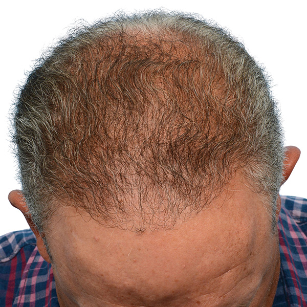 Fue Before and After | Dr. Jeffrey Wise