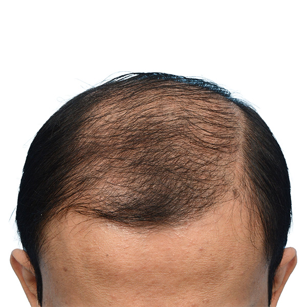 Fue Before and After | Dr. Jeffrey Wise