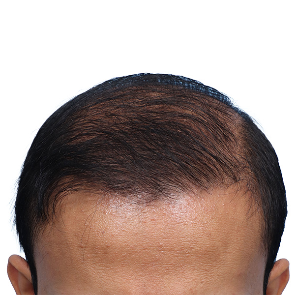 Fue Before and After | Dr. Jeffrey Wise