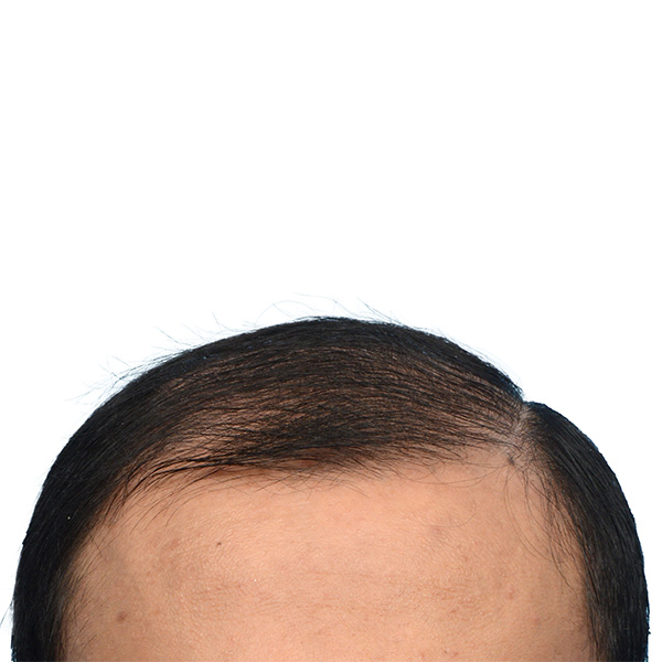 Fue Before and After | Dr. Jeffrey Wise