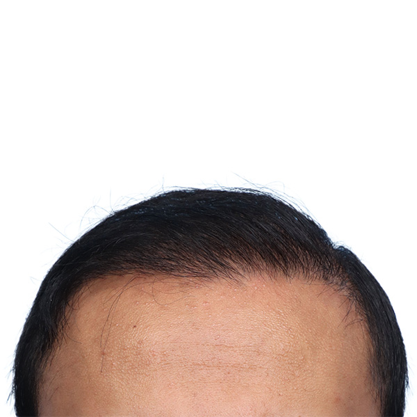 Fue Before and After | Dr. Jeffrey Wise