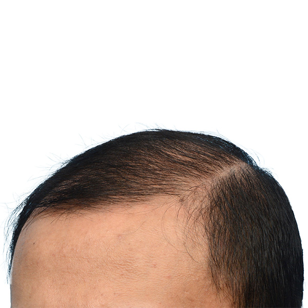 Fue Before and After | Dr. Jeffrey Wise