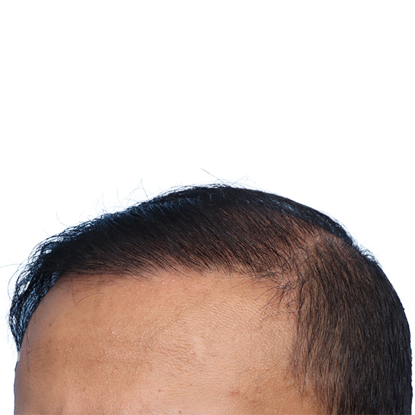 Fue Before and After | Dr. Jeffrey Wise