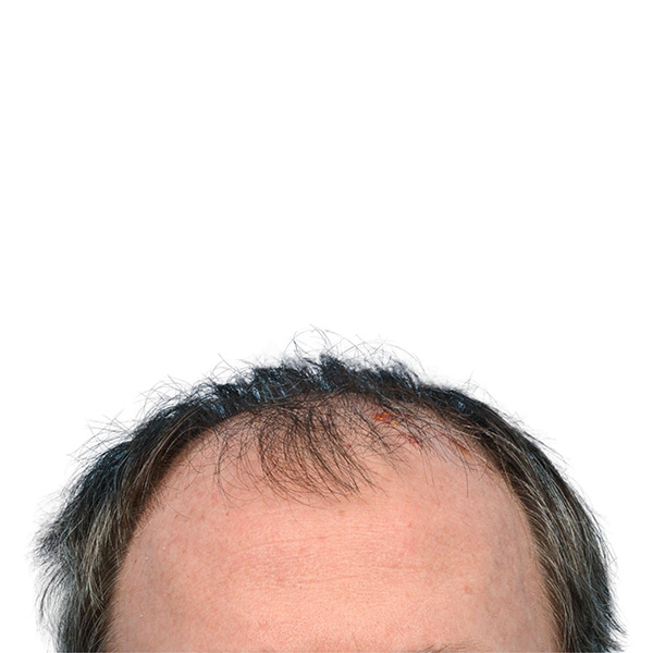 Fue Before and After | Dr. Jeffrey Wise