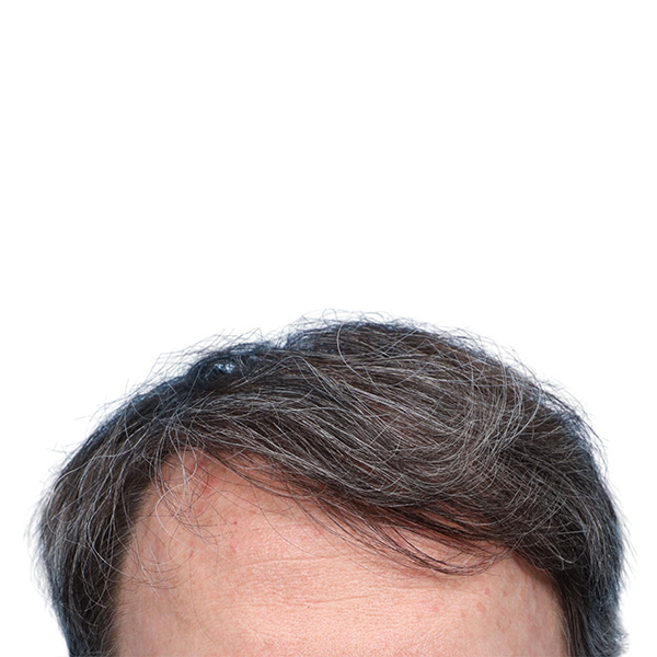 Fue Before and After | Dr. Jeffrey Wise