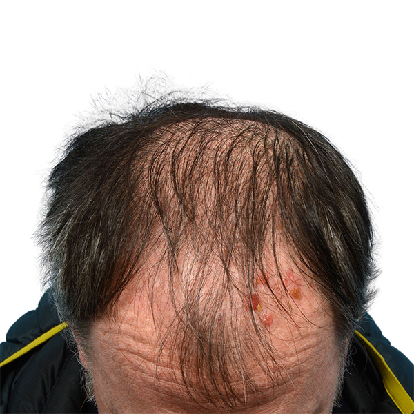 Fue Before and After | Dr. Jeffrey Wise