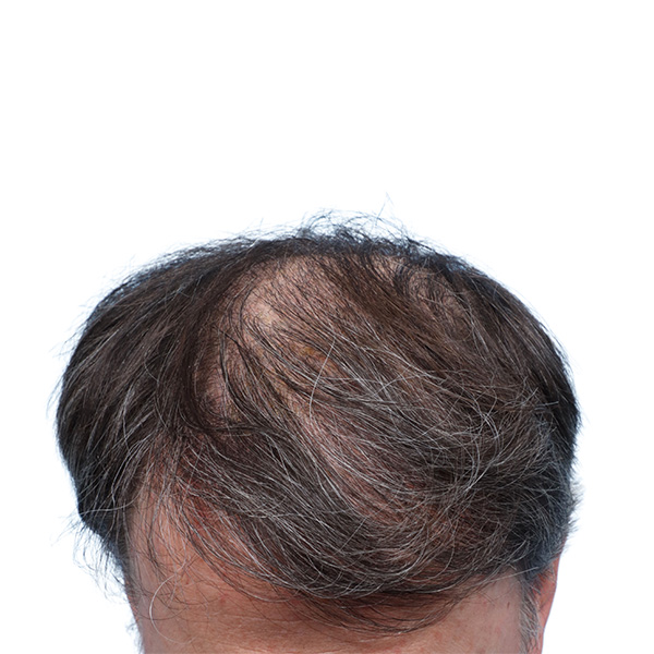 Fue Before and After | Dr. Jeffrey Wise