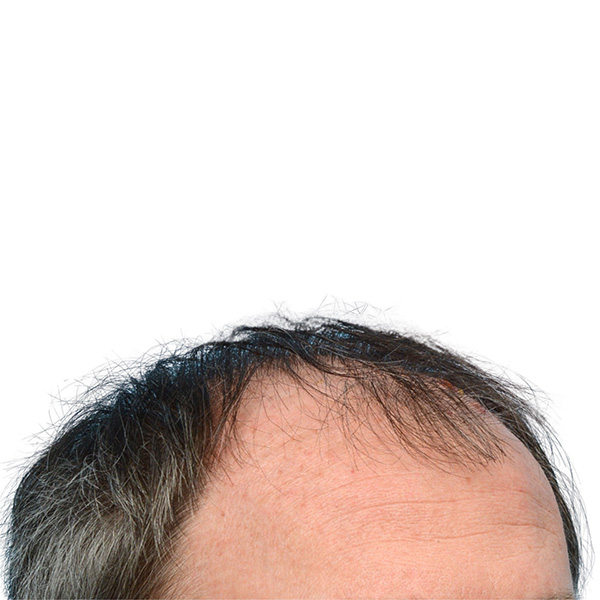 Fue Before and After | Dr. Jeffrey Wise