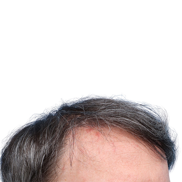 Fue Before and After | Dr. Jeffrey Wise