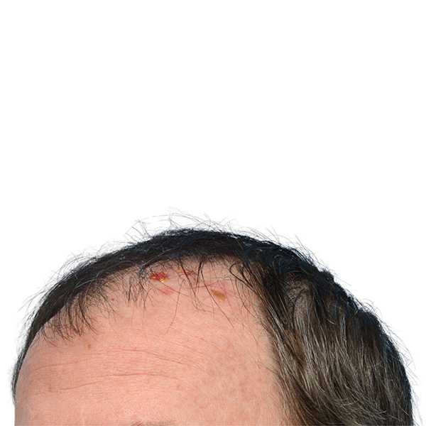 Fue Before and After | Dr. Jeffrey Wise