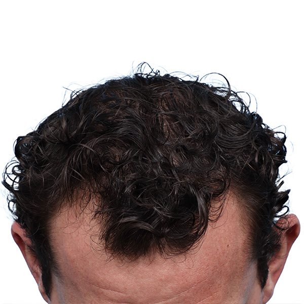 Fue Before and After | Dr. Jeffrey Wise