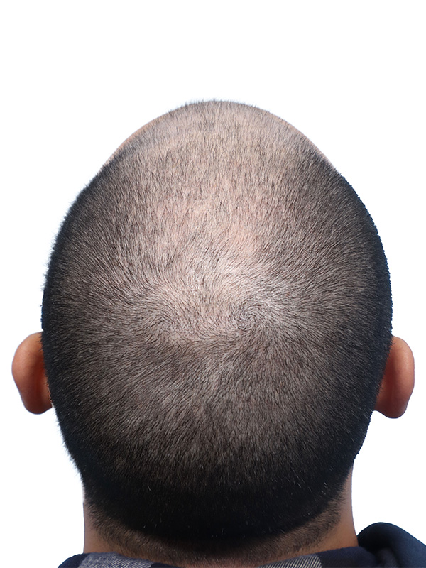 Fue Before and After | Dr. Jeffrey Wise