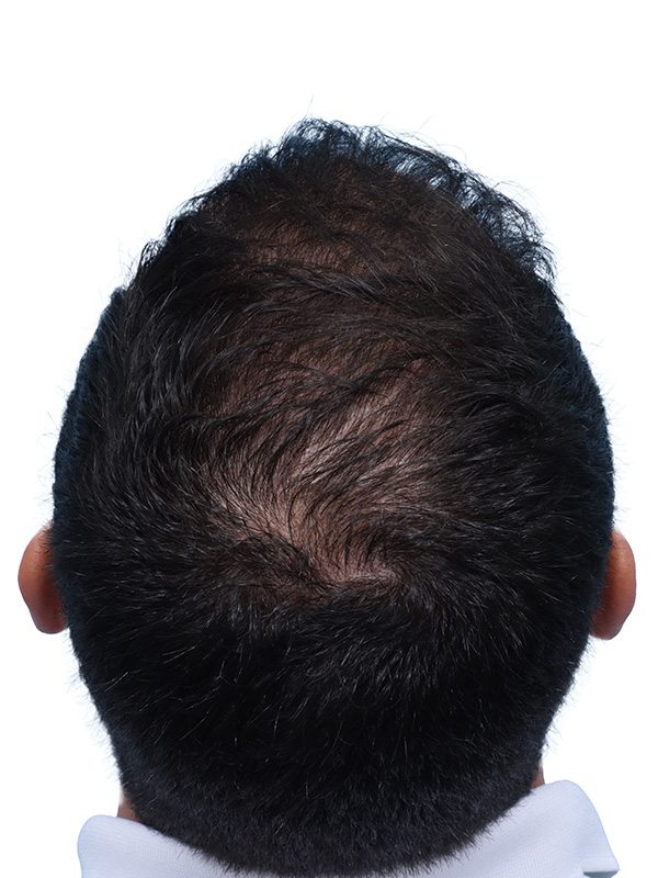 Fue Before and After | Dr. Jeffrey Wise