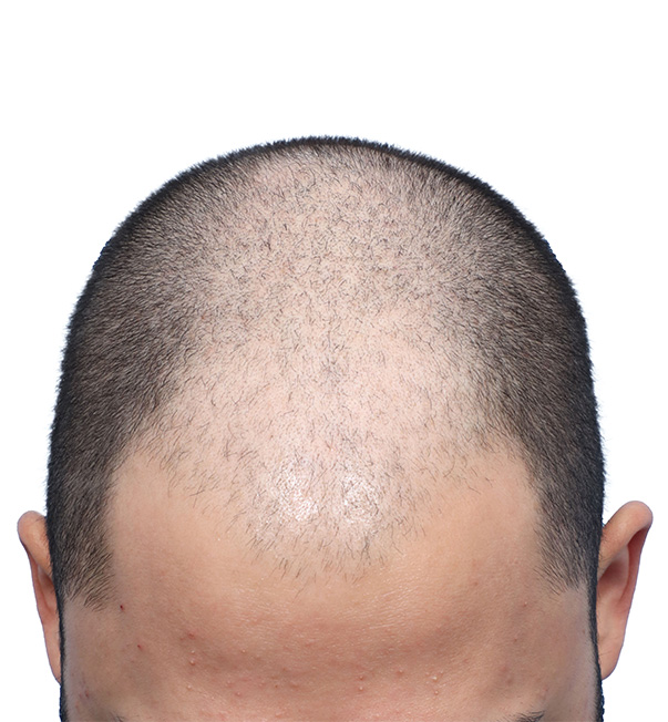 Fue Before and After | Dr. Jeffrey Wise