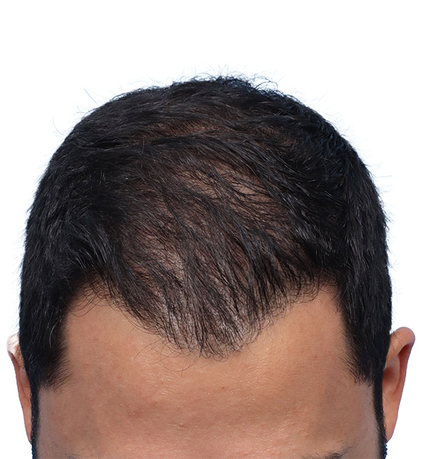 Fue Before and After | Dr. Jeffrey Wise