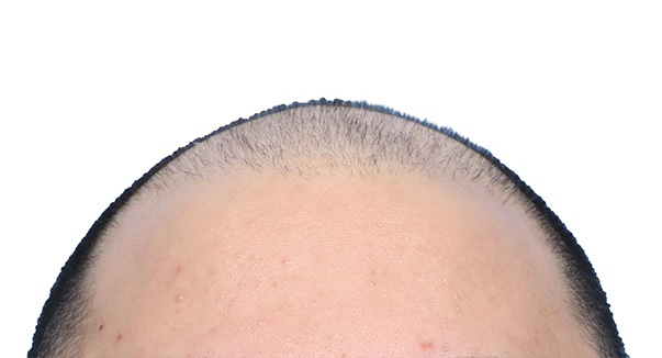 Fue Before and After | Dr. Jeffrey Wise