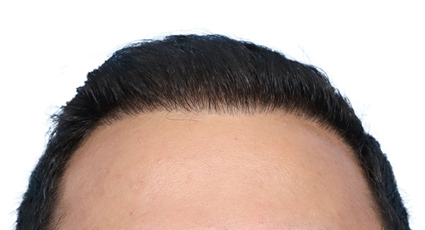 Fue Before and After | Dr. Jeffrey Wise