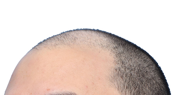 Fue Before and After | Dr. Jeffrey Wise