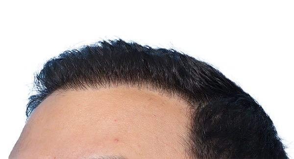 Fue Before and After | Dr. Jeffrey Wise