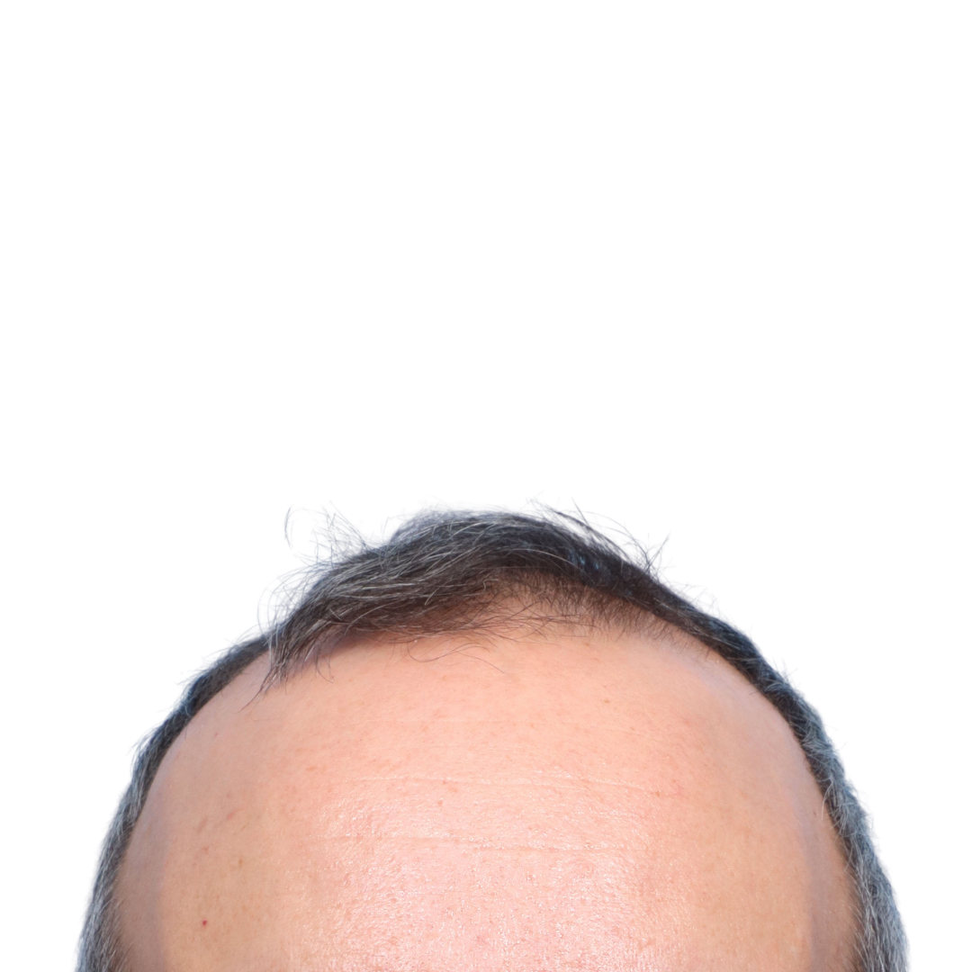 Fue Before and After | Dr. Jeffrey Wise