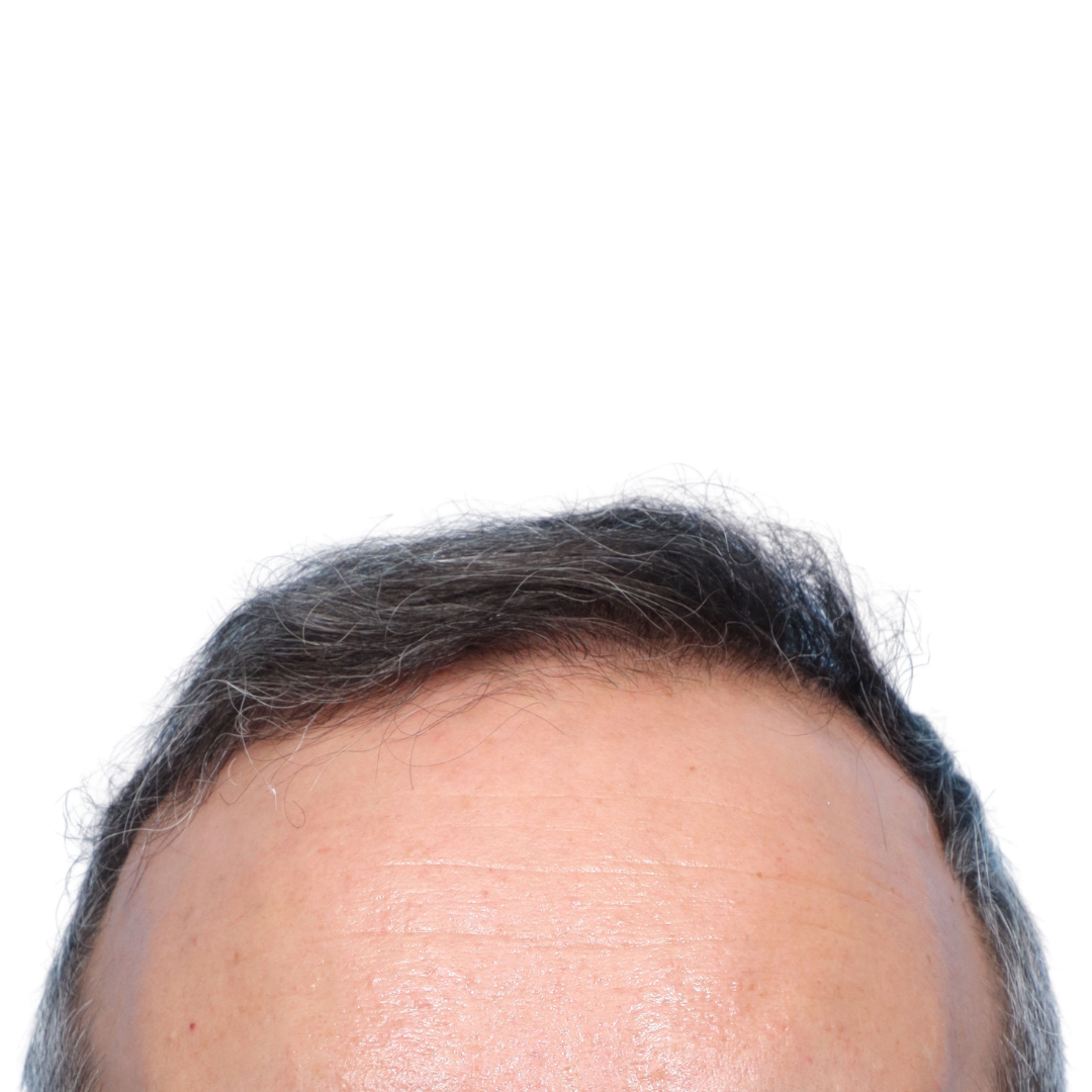 Fue Before and After | Dr. Jeffrey Wise