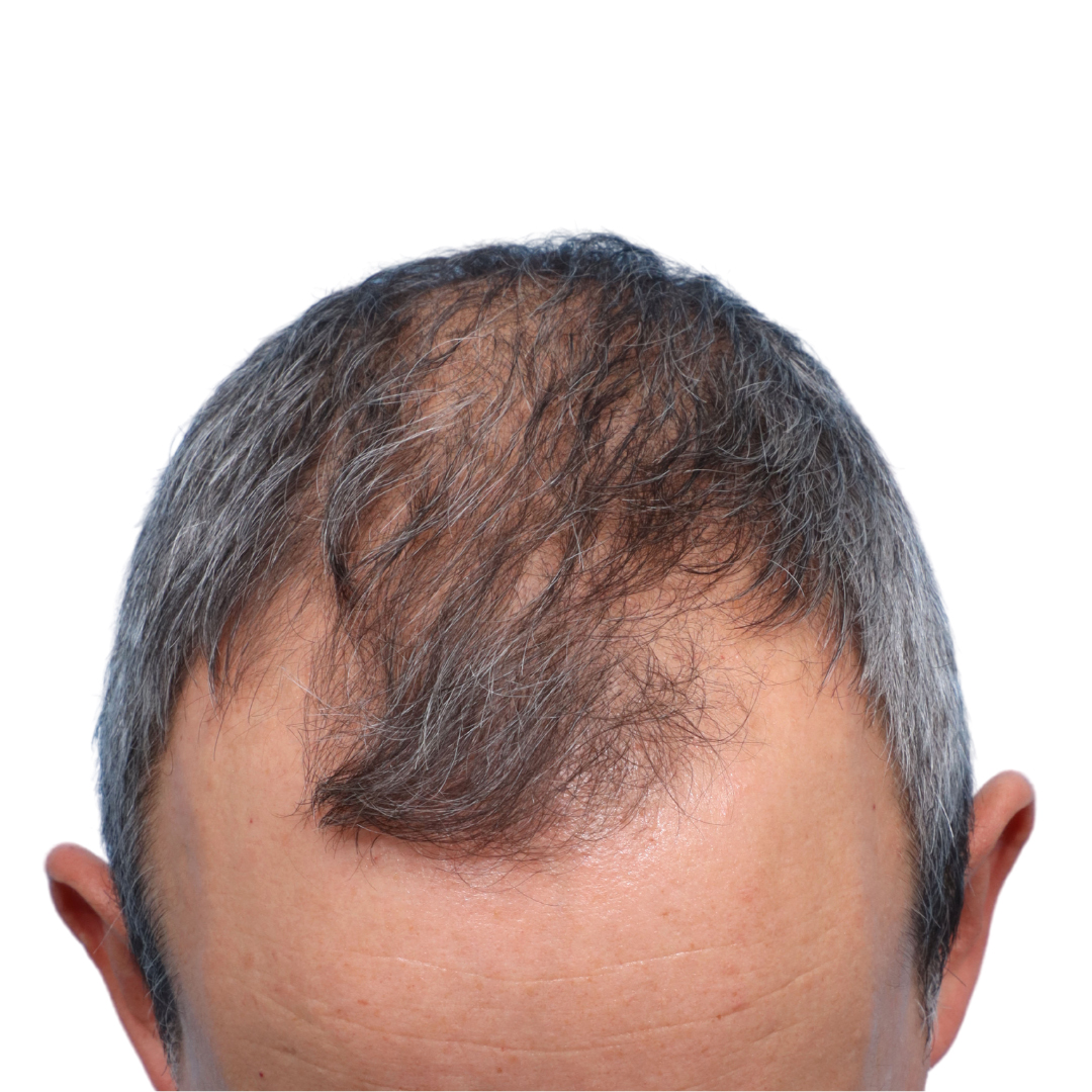 Fue Before and After | Dr. Jeffrey Wise