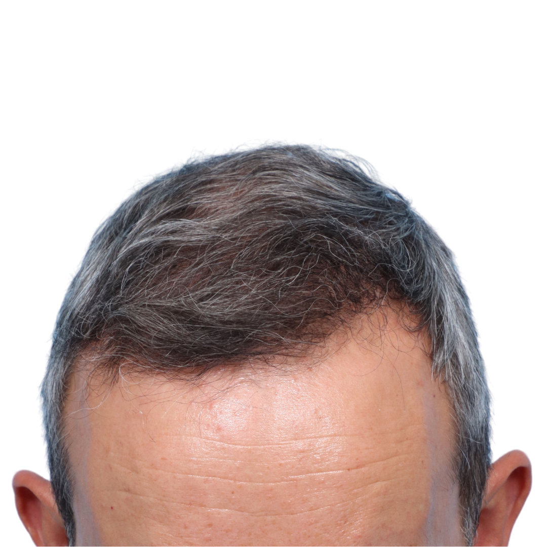 Fue Before and After | Dr. Jeffrey Wise