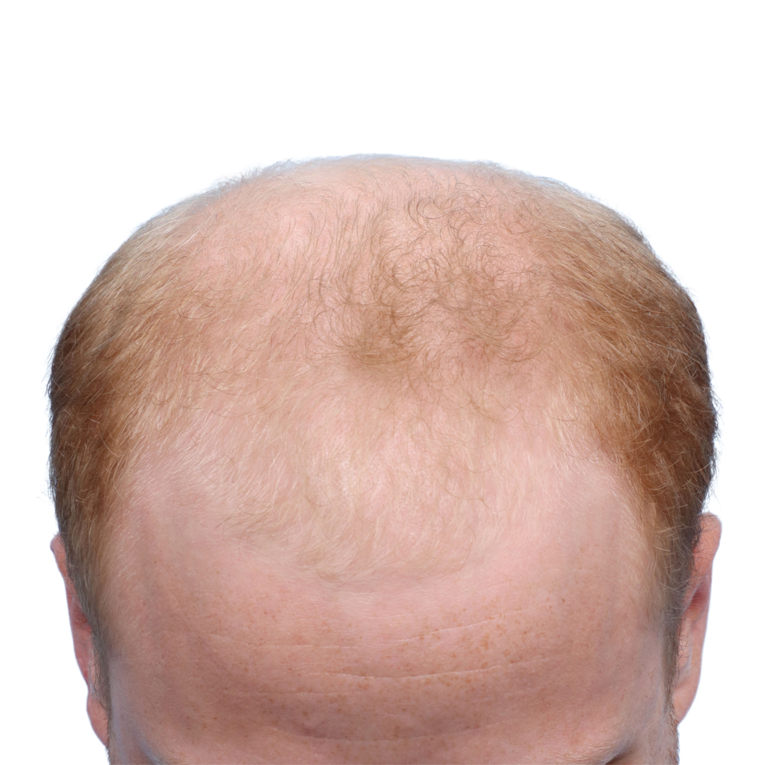 Fue Before and After | Dr. Jeffrey Wise