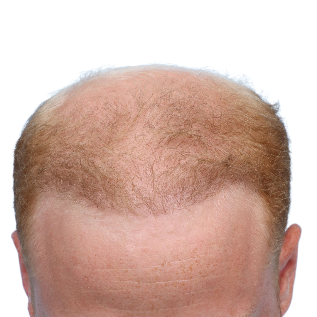 Fue Before and After | Dr. Jeffrey Wise