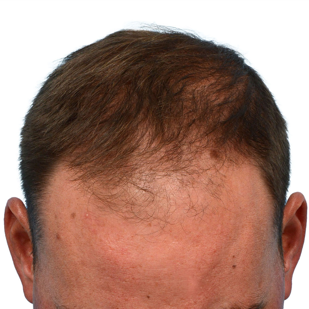 Fue Before and After | Dr. Jeffrey Wise