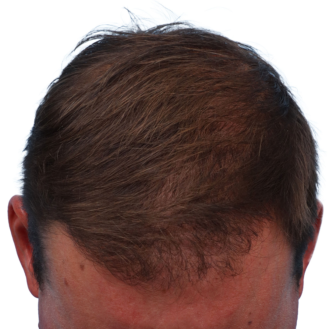 Fue Before and After | Dr. Jeffrey Wise