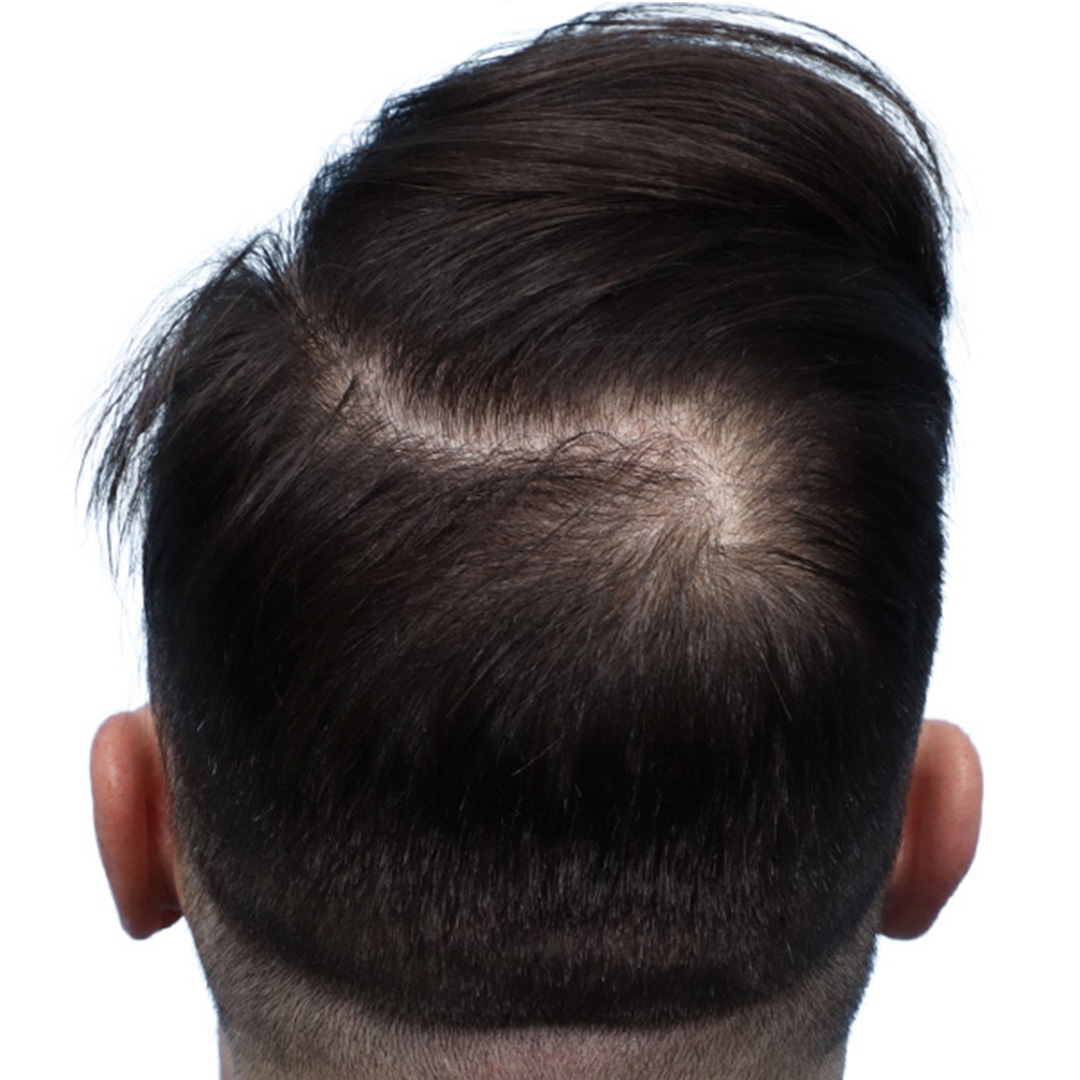 Fue Before and After | Dr. Jeffrey Wise